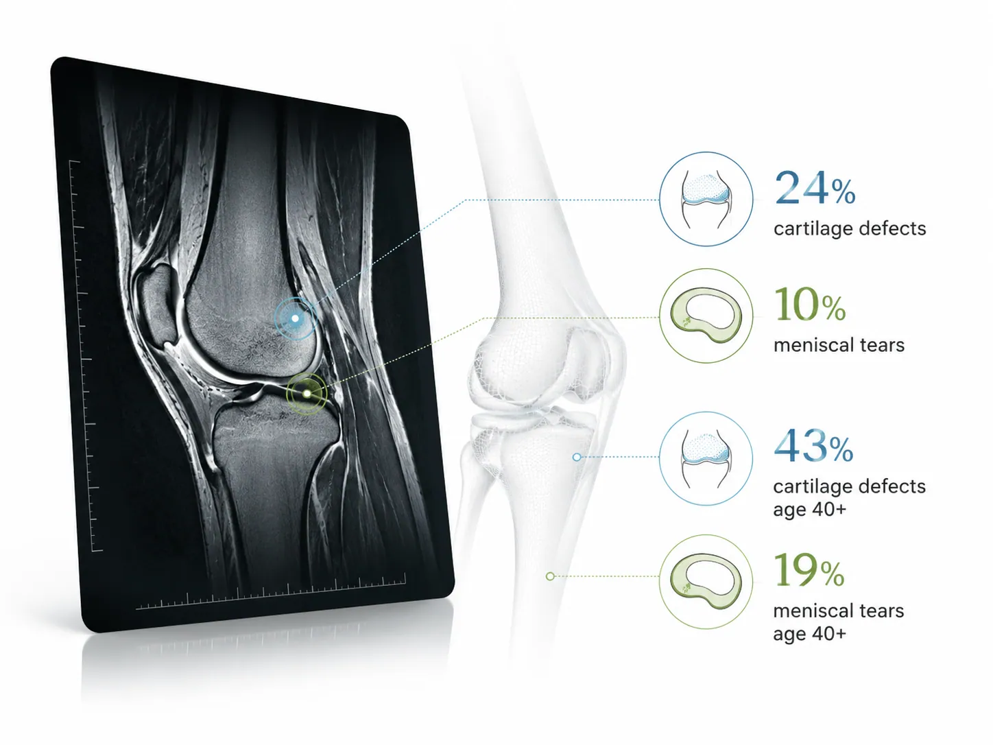 Knee MRI findings showing cartilage defects and meniscal tear statistics