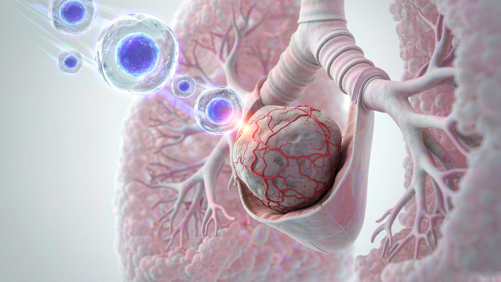 Three-dimensional view of a bronchial segment in lung tissue with a tumour nodule on the airway wall and a stream of glowing immune cells converging on it